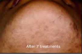 ingrown hair after chin